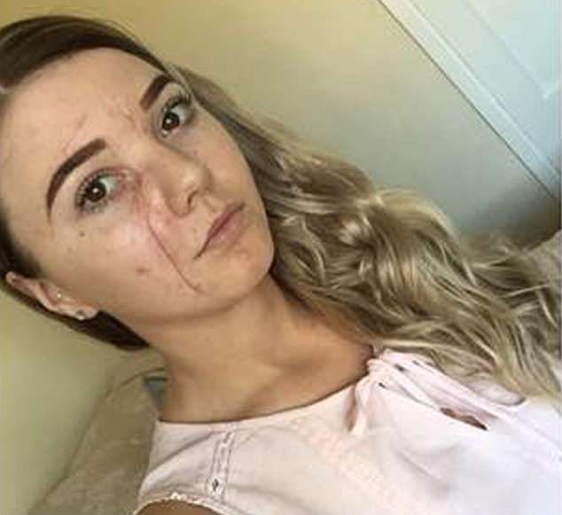 Жуткие шрамы на лице девушки, об голову которой в баре разбили бокал