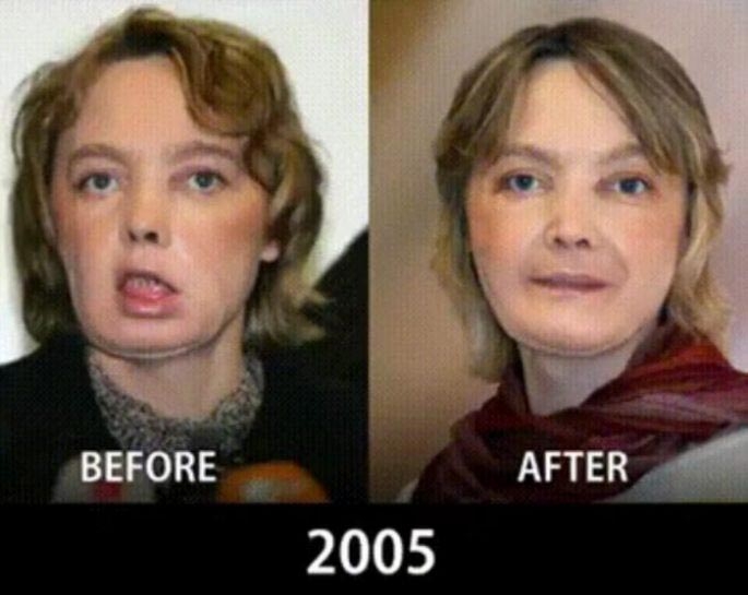 Сравнительные фотографии, показывающие как операции по пересадке лица продвинулись за 10 лет Сравнительные фотографии, показывающие как операции по пересадке лица продвинулись за 10 лет