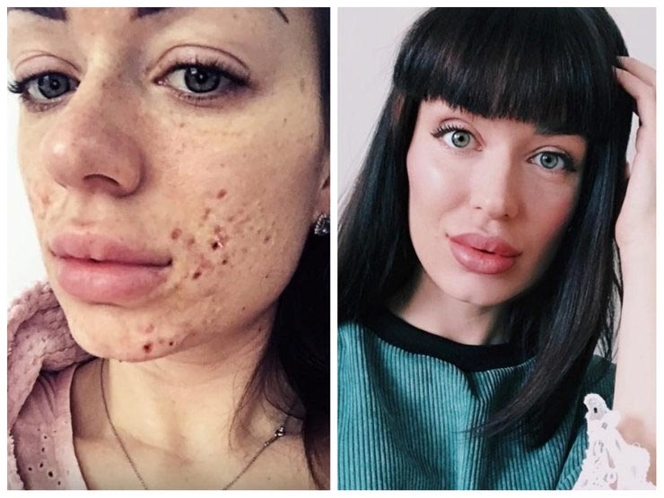 До и после акне: 5 реальных историй девушек, которые смогли победить прыщи До и после акне: 5 реальных историй девушек, которые смогли победить прыщи