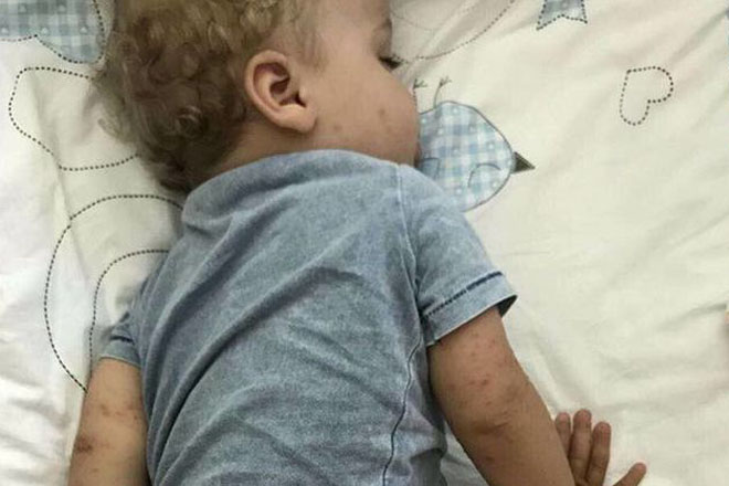 Вирус Коксаки: симптомы и последствия Вирус Коксаки: симптомы и последствия
