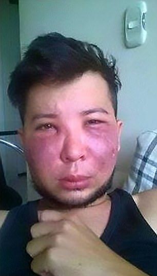 Лицо колумбийского модника после неудачной операции по увеличению щек