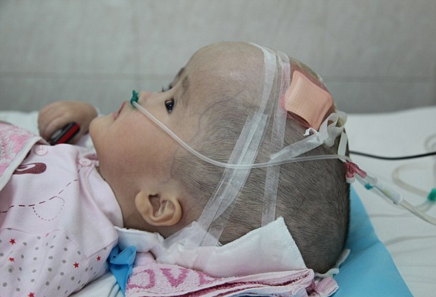 3-летней девочке в Китае пересадили череп, напечатанный на 3D-принтере 3-летней девочке в Китае пересадили череп, напечатанный на 3D-принтере