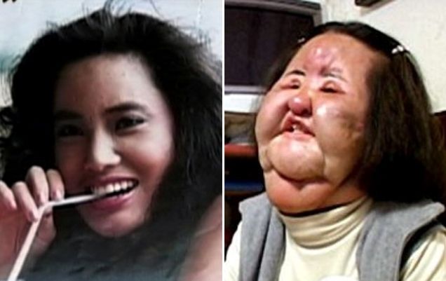 Жертвы пластической хирургии