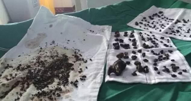 Хирурги извлекли из организма женщины две сотни камней