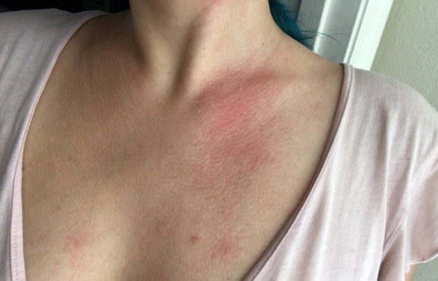Девушка с редчайшей аллергией