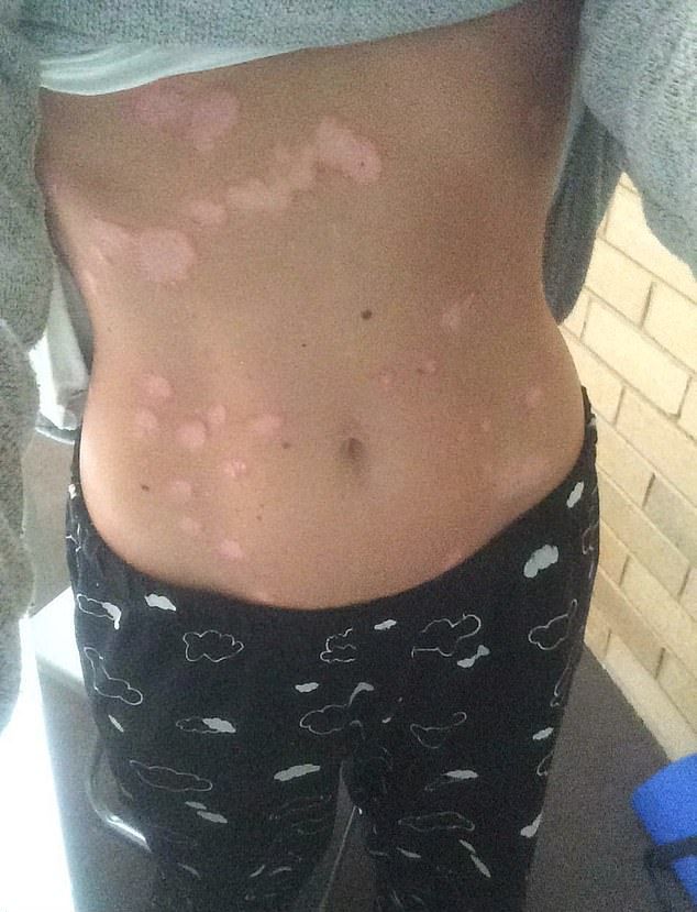 Девушка с псориазом приняла и полюбила свою далматиновую кожу
