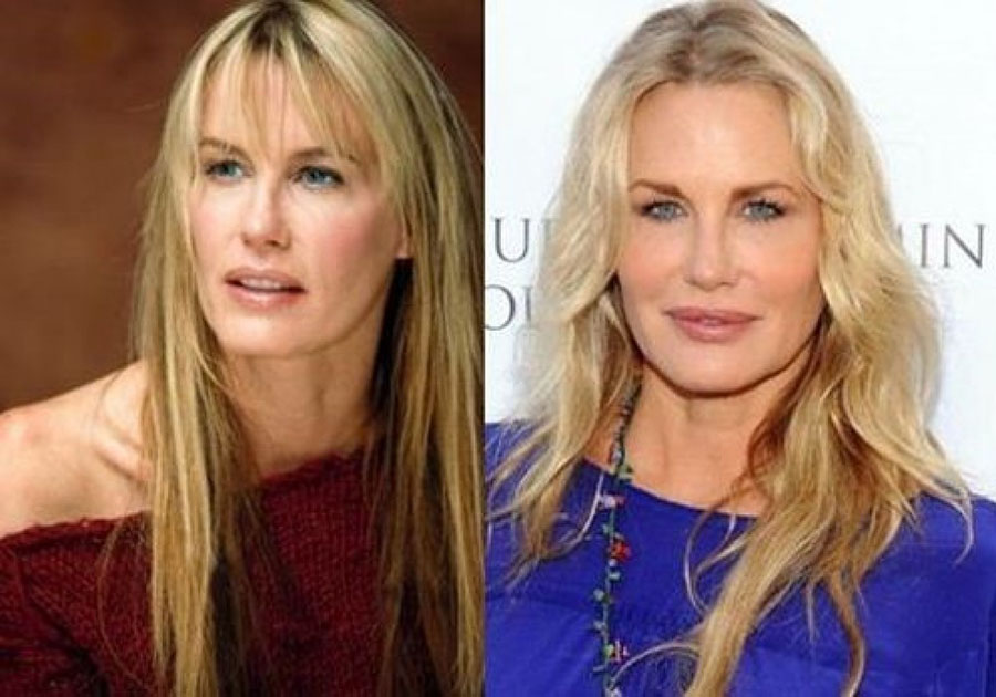 Знаменитости, которых изменил ботокс Знаменитости, которых изменил ботокс