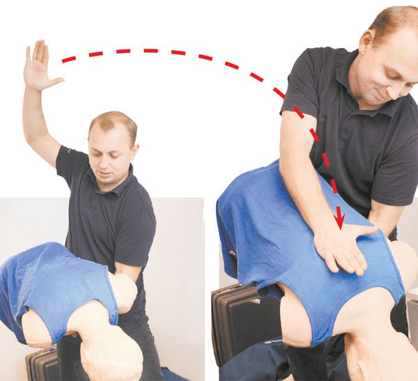 Первая доврачебная помощь: что делать, если кто-то подавился