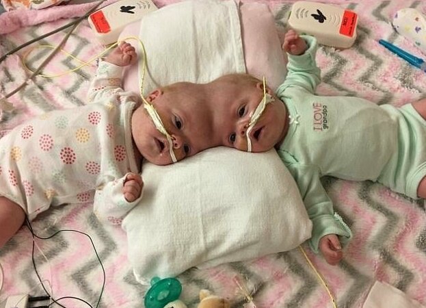 Право на жизнь: 1,5-годовалые сиамские близнецы, родившиеся со сращенными головами, восстановились после сложнейшей операции и радуются каждому дню Право на жизнь: 1,5-годовалые сиамские близнецы, родившиеся со сращенными головами, восстановились после сложнейшей операции и радуются каждому дню