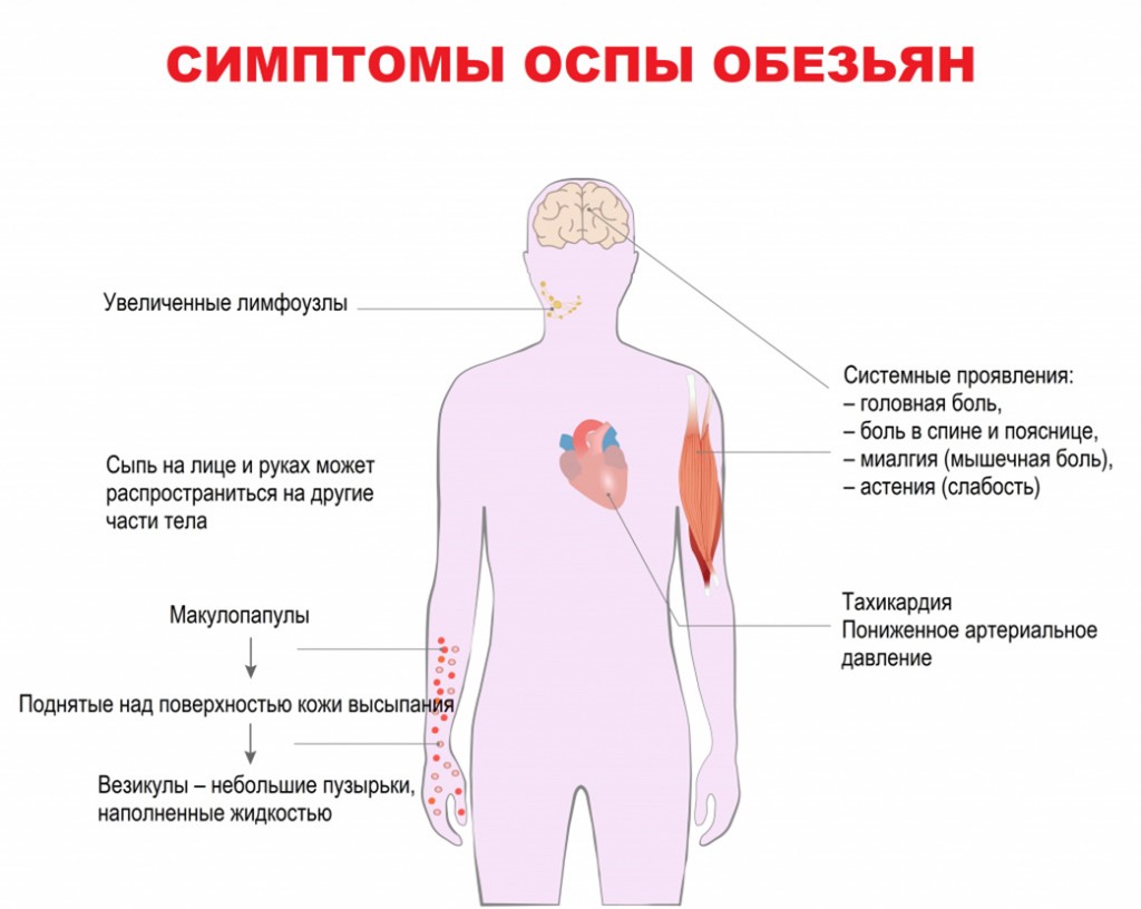 В Подмосковье госпитализированы пятеро с подозрением на оспу обезьян